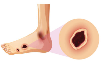 Revised Diabetic Foot Screen