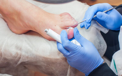 Is Toenail Fungus that big a deal?