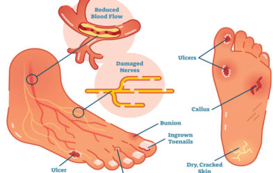 So, What About the Diabetic Foot?