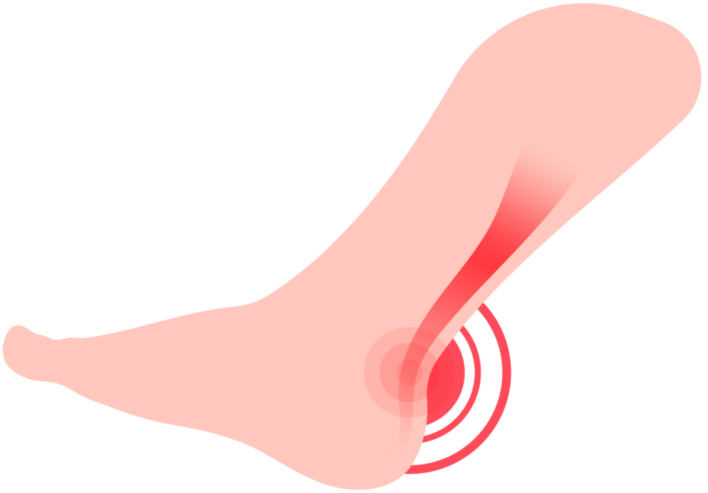 Illustration of a foot with the Achilles tendon highlighted, indicating the typical location of Achilles tendonitis pain.