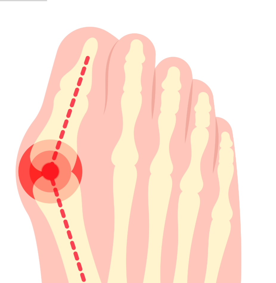 Illustration of the inner foot bone structure showing misaligned bones at the base of the big toe, causing a bunion.