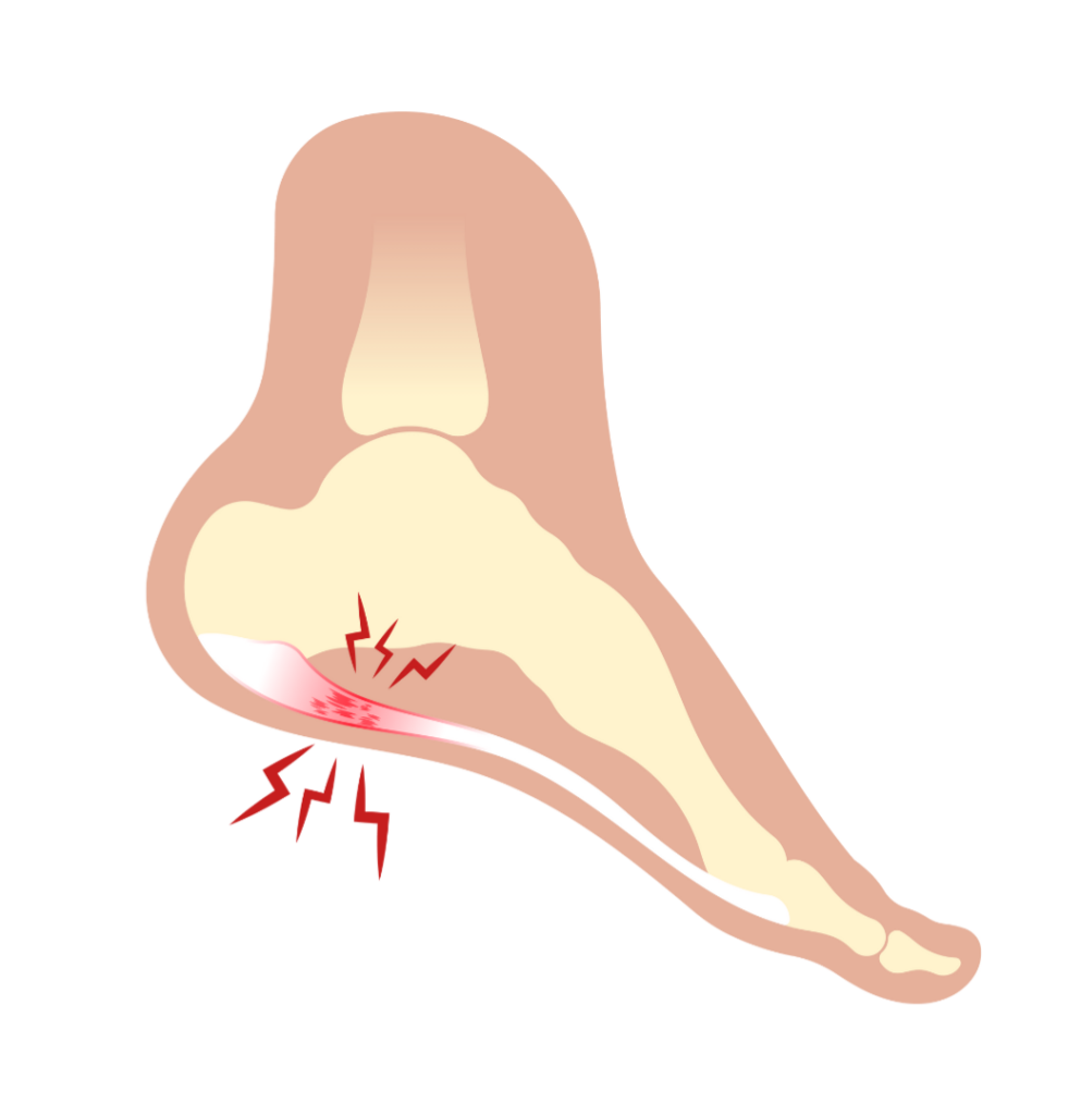 Illustration of a foot with plantar fasciitis, showing inflammation and tears in the plantar fascia tissue near the heel.