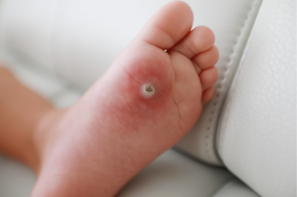 Image of a foot with a plantar wart: A close-up image of a foot showing a round, raised, and rough growth on the sole