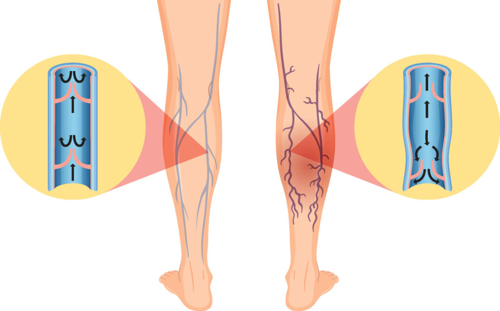 An anatomical illustration comparing a healthy leg with one affected by varicose veins.
Left side (healthy leg): Shows a smooth, flesh-toned leg with a magnified cross-section of a healthy vein. Inside the vein, blue arrows point upwards, indicating proper blood flow back to the heart.
Right side (affected leg): Depicts a leg with visibly enlarged, twisted, and purplish varicose veins. A similar magnified cross-section shows disrupted blood flow, with some blue arrows pointing downwards, suggesting blood pooling due to weakened valves.